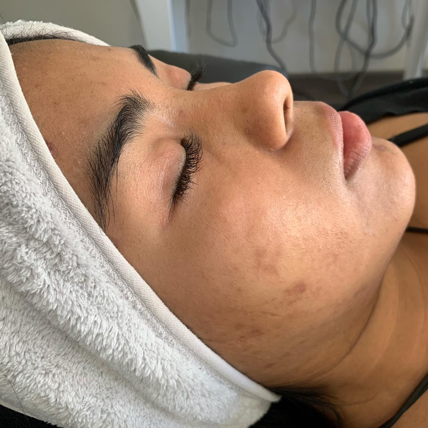 Tratamiento de radiofrecuencia y cosmetología en Guadalajara